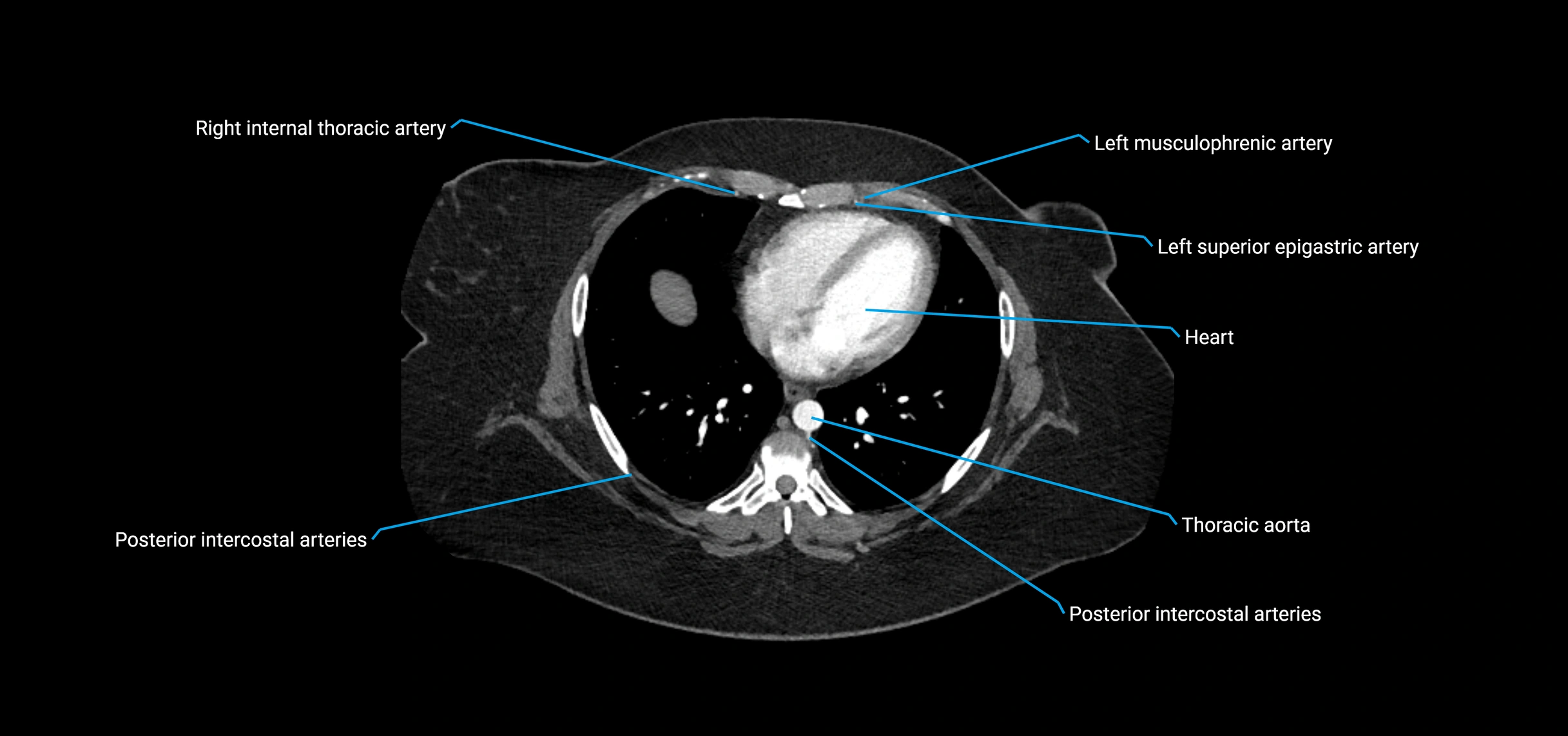 CTA abdomen axial cross sectional anatomy labelled image_3 (1).webp